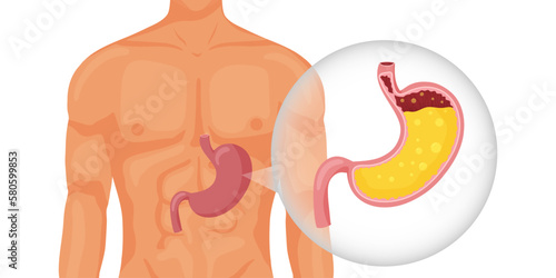 Human stomach full of gastric juice in body
