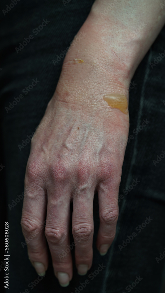 Close-up of a woman's hand with a blister from a boiled water burn, damaged skin, 1st or second degree burn. Painful wound. Thermal burn. Water bladder from a burn, wound treatment.Macro photo