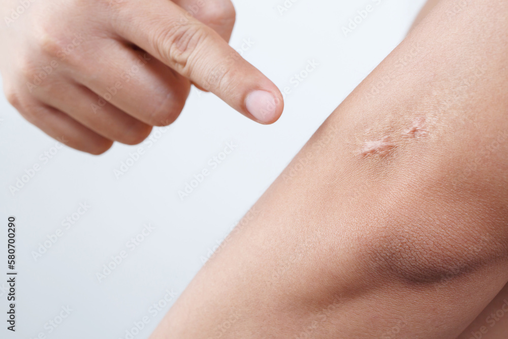 man arm scar caused by surgery man arm scar caused by surgery