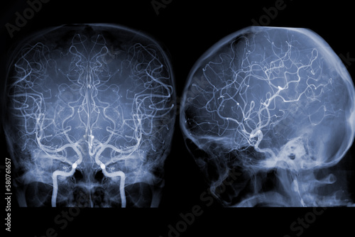Cerebral angiography  image from Fluoroscopy in intervention radiology  showing cerebral artery.