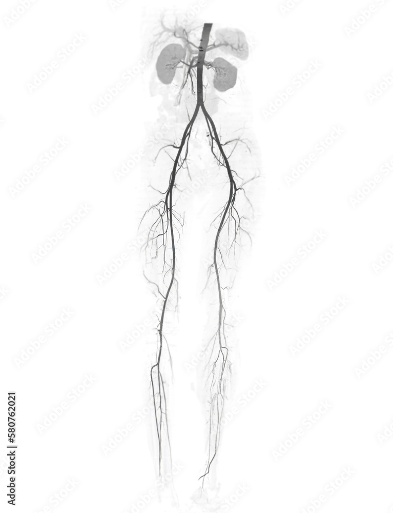 CTA femoral artery run off showing femoral artery for diagnostic Acute