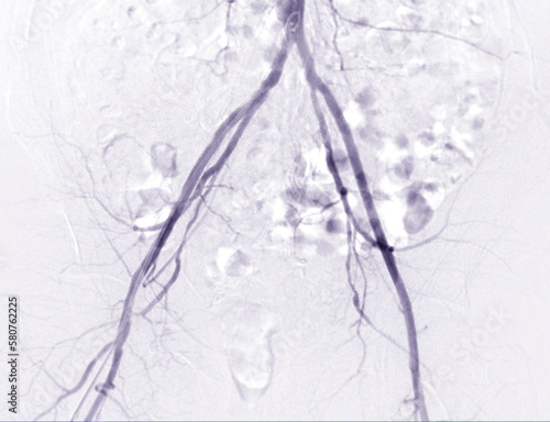 Femoral artery angiogram or angiography