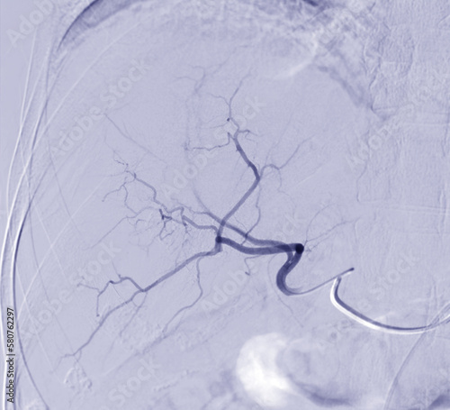 Imaging of TACE or Chemoembolization is a procedure that allows a dose of chemotherapy drugs to be administered directly to Liver tumor or HCC showing hepatic artery. photo