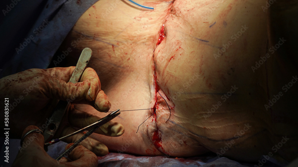 tummy tuck surgery. Doctor performs tummy tuck surgery with cautery - obrazy, fototapety, plakaty 