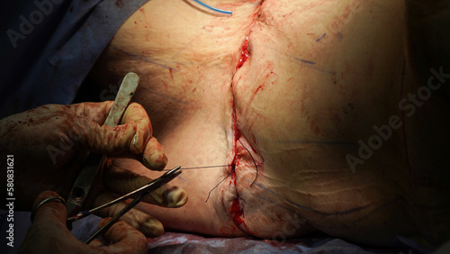 tummy tuck surgery. Doctor performs tummy tuck surgery with cautery photo