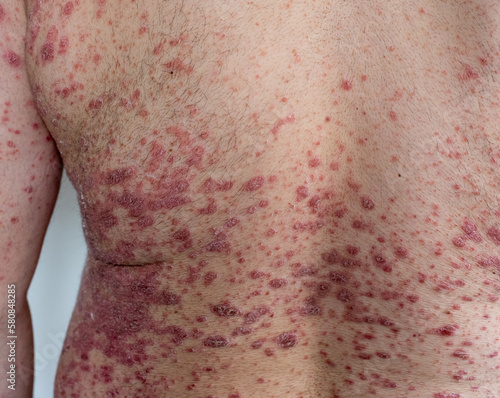 A man with psoriasis