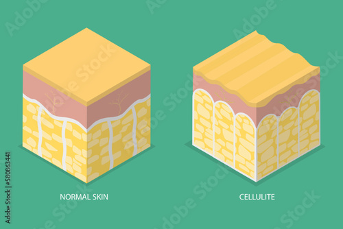 3D Isometric Flat Vector Conceptual Illustration of Cellulite Skin, Womans Beauty and Skicare