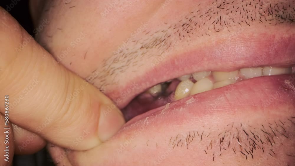 man-shows-seam-put-with-black-thread-on-gum-after-tooth-implantation