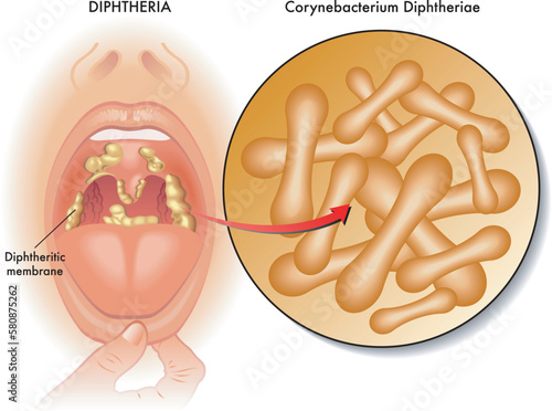 Medical illustration of symptoms of diphtheria, with annotations.  photo