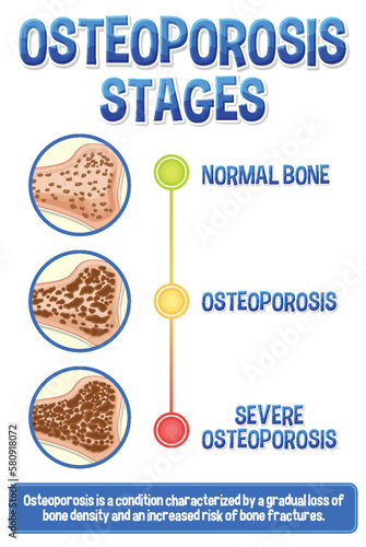 Informative poster of Osteoporosis human bone