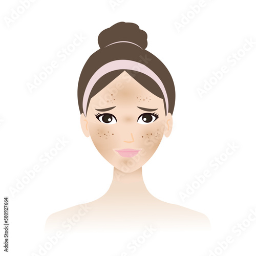 Hyperpigmentation and melasma is on the woman face vector isolated on white background. A patchy dark brown and spots is on the skin face, cheeks, nose, upper lip and forehead. Skin problem concept.