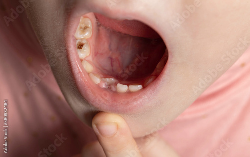 The child has a wrong tooth. Eruption of a permanent tooth in children, close-up photo