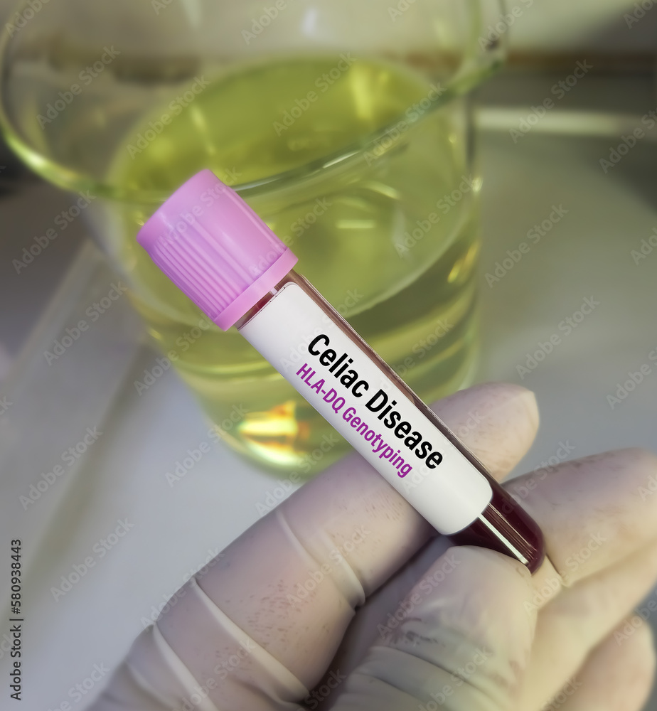 Blood sample for Celiac disease HLADQ genotyping test. Celiac Disease Tests. autoimmune