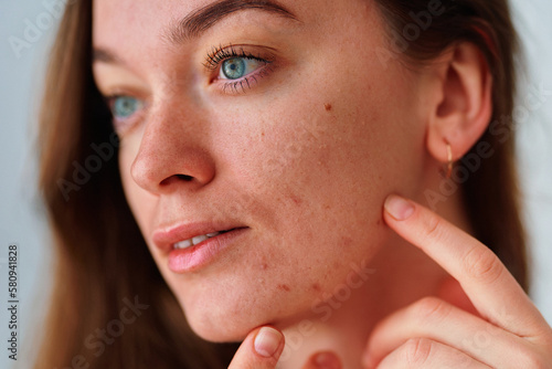 Young woman with problem skin and acne closeup photo