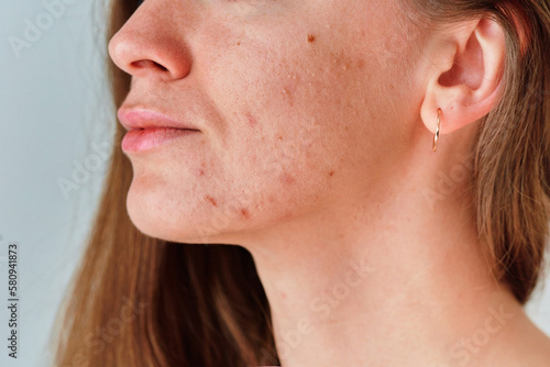 Young woman suffering from problem skin and acne closeup © Goffkein