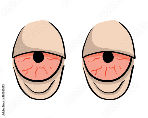 Red hand-drawn eyes. Problem of insomnia. Sleep disorder with capillaries and pupils. Comic drawing. Fatigue and stress. Conjunctivitis infection. Blood eyeballs. Sick illness look