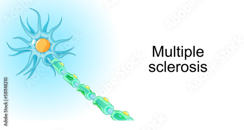 Multiple sclerosis. demyelinating disease. autoimmune disease. Vector