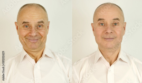 elderly caucasian male face with puffiness under eyes and wrinkles before and after treatment, two shots cosmetic procedures, mature man, senior 60 years old, age-related skin changes, plastic surgery