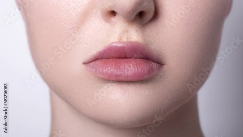 Rosacea couperose redness skin treatment, before and after result of IPL laser treatment, red spots on cheeks, young woman with sensitive skin, patient face close-up