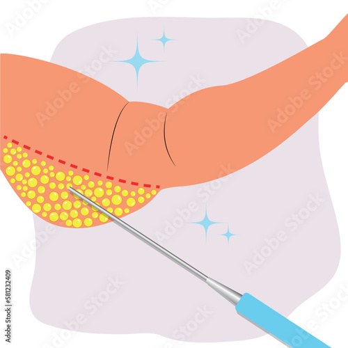 Fat arm of woman. Lipedema fat deposits. Liposuction concept