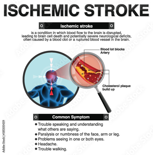 Informative poster of Ischemic stroke