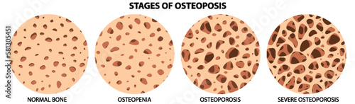 Stages of Osteoposis Vector