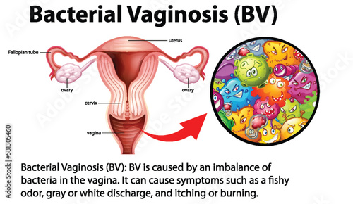 Bacterial Vaginosis (BV) infographic with explanation