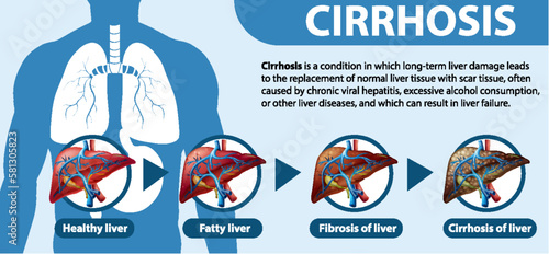 Informative poster of alcoholic liver disease Cirrhosis