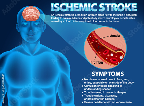 Informative poster of Ischemic stroke