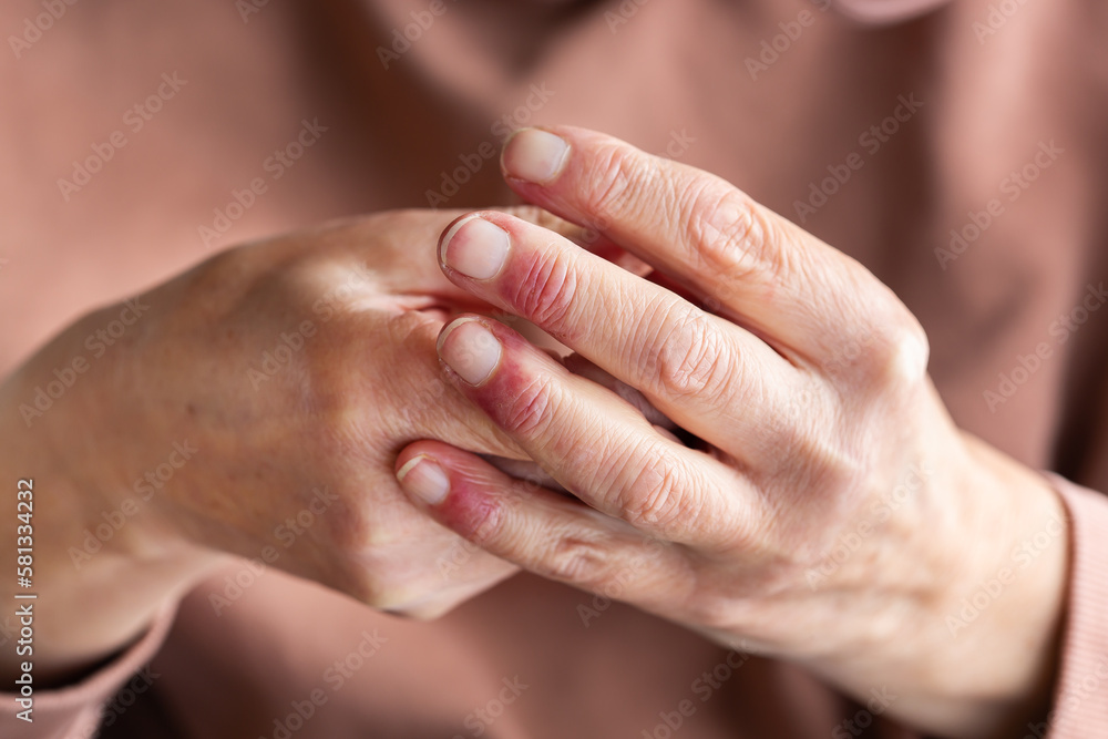 Fototapeta premium Woman hands with atopic dermatitis, eczema, allergy reaction on skin