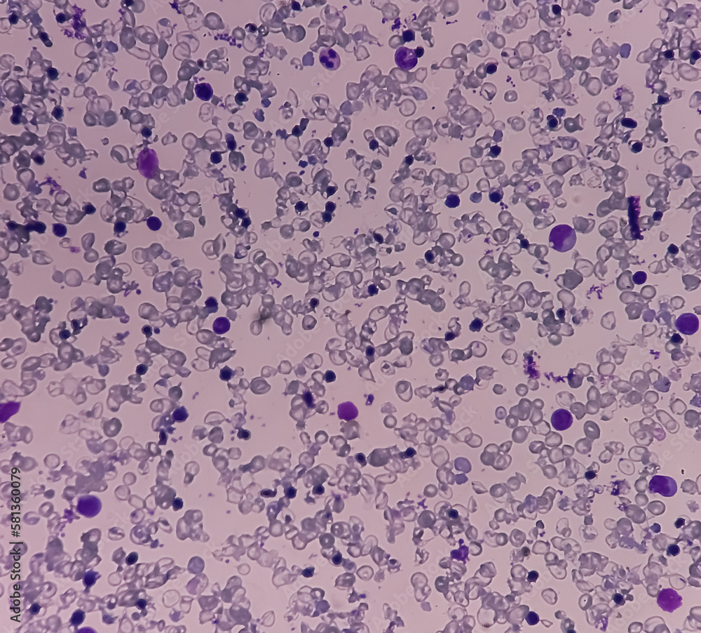 Hereditary hemolytic anemia. Hemoglobin E (HbE) disease. Smear show 90