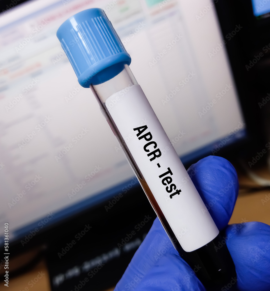 Blood sample for APCR(Activated protein C resistance) test. Screening