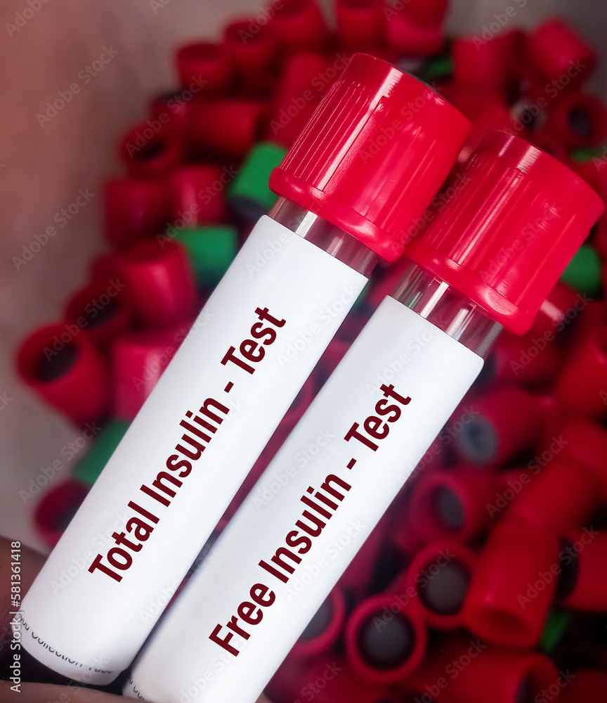 Lab Technologist holds blood samples for Serum Insulin (total and free