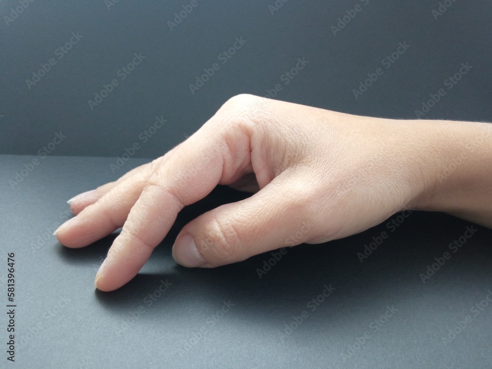 Irritation on the hand. Dryness and peeling of a woman's hand in close-up isolated on a black background. Skin problems in cosmetology.