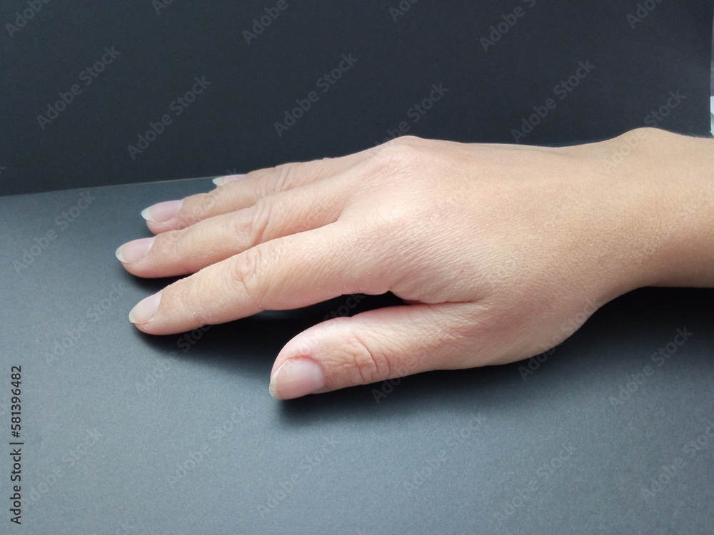 Irritation on the hand. Dryness and peeling of a woman's hand in close-up isolated on a black background. Skin problems in cosmetology.