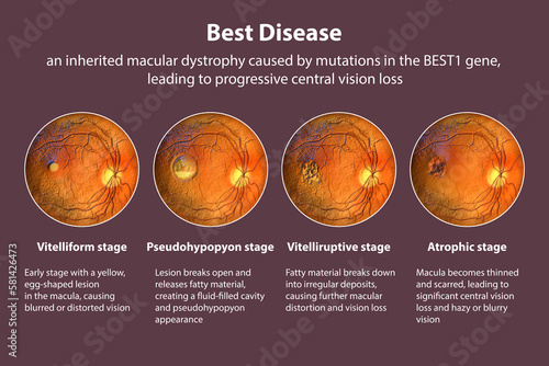 Cuadro en lienzo Stages of Best vitelliform macular dystrophy, 3D illustration