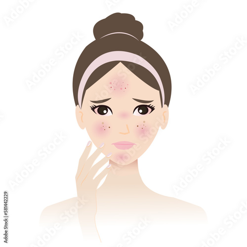 The skin allergy on woman face vector isolated on white background. The allergic reaction skin becomes irritated, rash, itching, burning, redness, bumps, hives, and swelling. Skin problem concept.