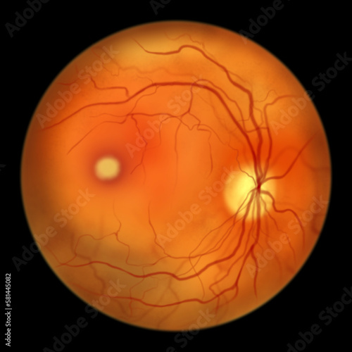 Best vitelliform macular dystrophy, vitelliform stage, classic egg-yolk lesion, illustration photo