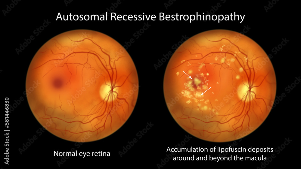 Autosomal recessive bestrophinopathy, illustration showing normal eye ...
