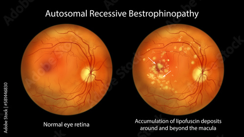 Autosomal recessive bestrophinopathy, illustration showing normal eye retina and accumulation of lipofuscin deposits around and beyond the macula