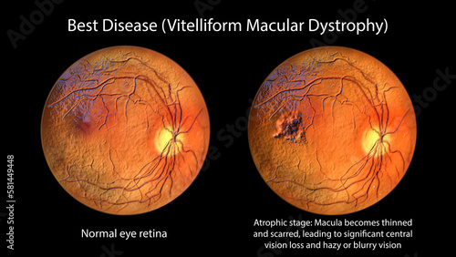 Best disease, 3D illustration showing normal eye retina and Best vitelliform macular dystrophy in atrophic stage with retinal atrophy and scar formation