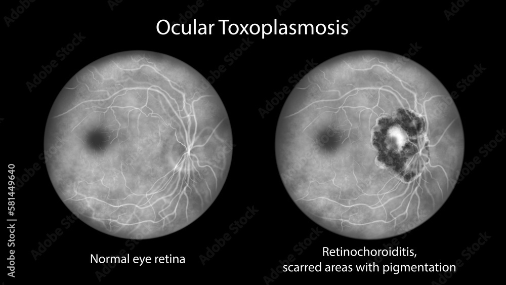 Retinal scar caused by a Toxoplasma gondii infection, or toxoplasmosis