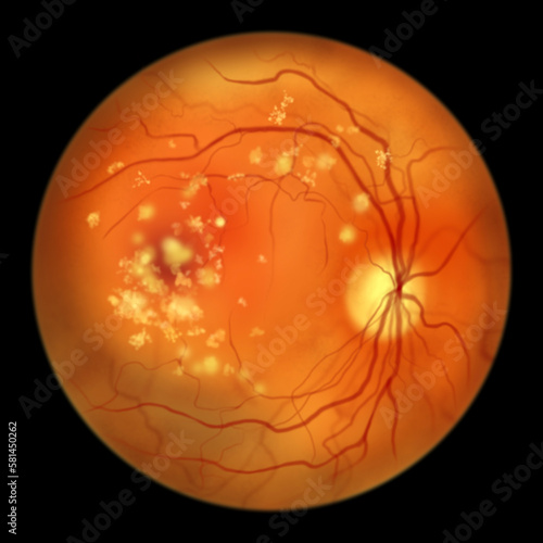 Autosomal recessive bestrophinopathy, ophthalmoscope view, scientific illustration showing accumulation of lipofuscin deposits around and beyond the macula photo