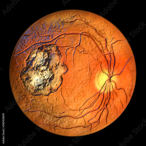 Retinal scar caused by a Toxoplasma gondii infection, or toxoplasmosis, 3D illustration