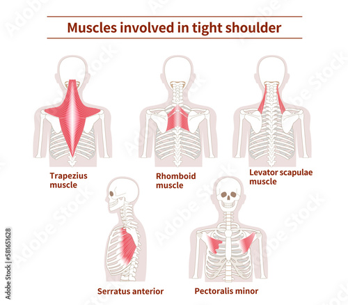 Muscle sets in the back that cause tight shoulder
