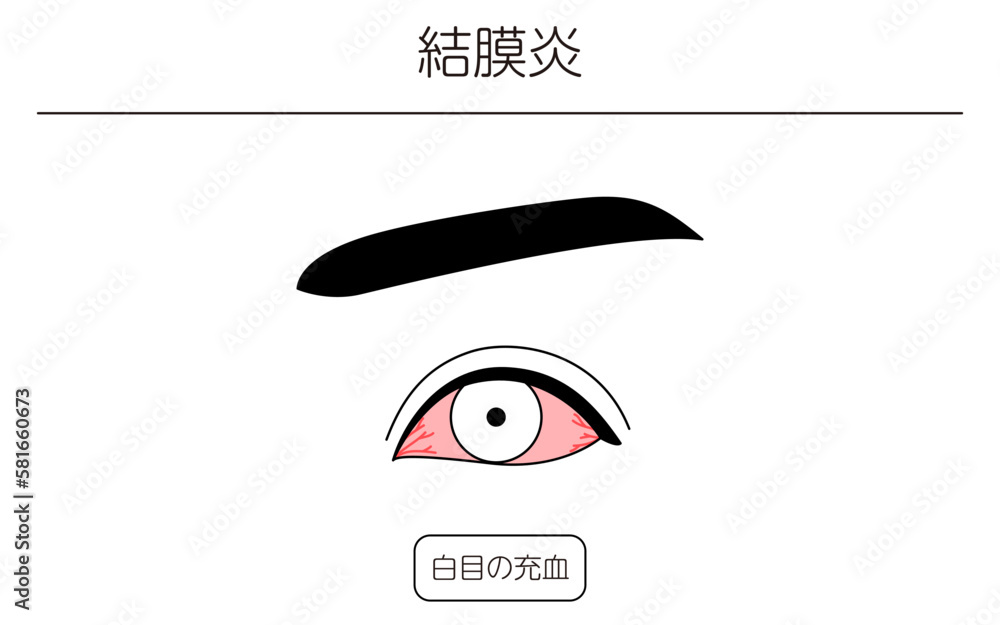 医療イラスト、眼病・結膜炎の線画イラスト