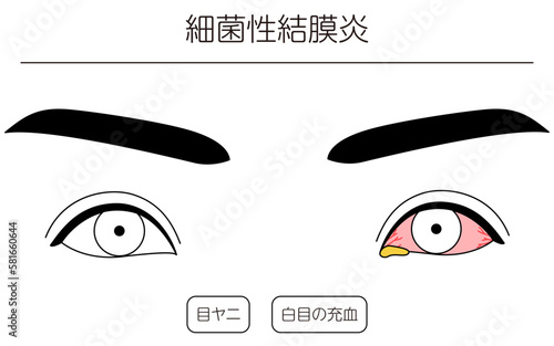医療イラスト、眼病・細菌性結膜炎の線画イラスト