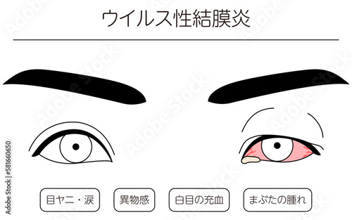 医療イラスト、眼病・ウイルス性結膜炎の線画イラスト