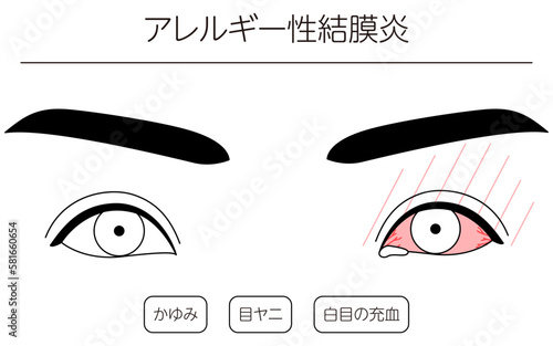 医療イラスト、眼病・アレルギー性結膜炎の線画イラスト