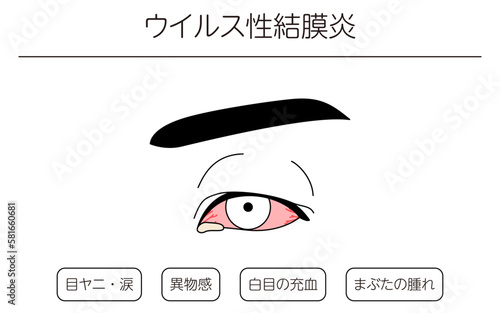 医療イラスト、眼病・ウイルス性結膜炎の線画イラスト